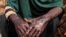 A Sudanese woman, pictured on Aug. 5, 2023 at her makeshift shelter in Adre, Chad, shows burn scars on her hands that she sustained in April 2023, after Rapid Support Forces and Arab militia forces torched the camp where she was living in El Geneina.