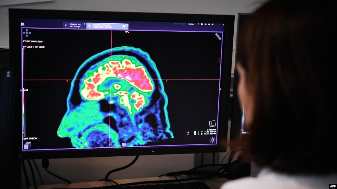 FILE - A picture of a human brain taken by a positron emission tomography scanner, also called PET scan, is seen on a screen, Jan. 9, 2019, at the Regional and University Hospital Center of Brest, western France.
