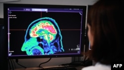 FILE - A picture of a human brain taken by a positron emission tomography scanner, also called PET scan, is seen on a screen, Jan. 9, 2019, at the Regional and University Hospital Center of Brest, western France.