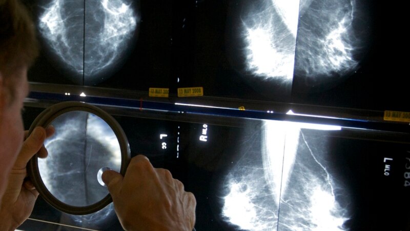 Mammograms should now start at 40, US panel says 