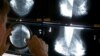 US Requires New Info on Breast Density With All Mammograms 