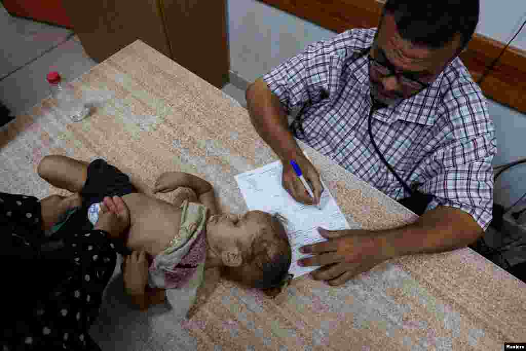 A Palestinian girl is examined by a doctor amid fears over the spread of polio after the first case was reported by the Ministry of Health, at Al-Aqsa Martyrs Hospital, in Deir Al-Balah in the central Gaza Strip.