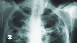 Saúde em Foco: Luta Mundial contra a Tuberculose