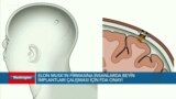 Elon Musk'ın firmasına insanlarda beyin implantları çalışması için FDA onayı 