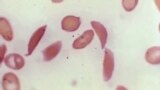 FILE - This microscope photo provided on Oct. 25, 2023, by the Centers for Disease Control and Prevention shows crescent-shaped red blood cells from a sickle cell disease patient in 1972. 