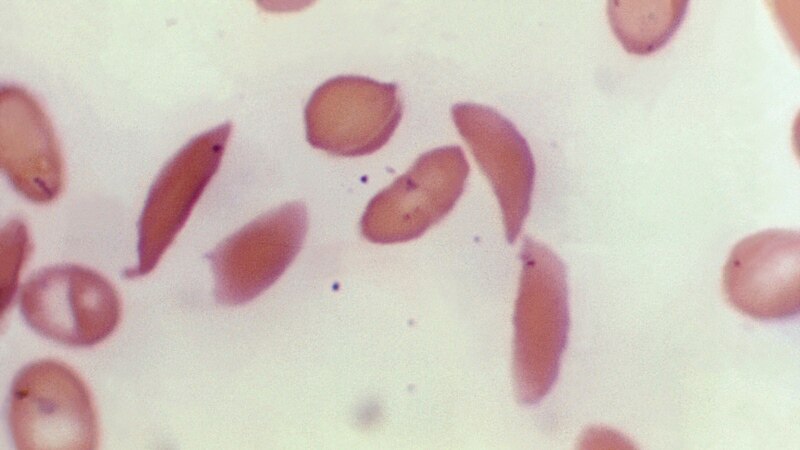 US Approves Two Gene Therapies for Sickle Cell Disease ...