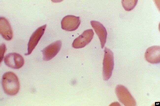 This microscope photo provided by the Centers for Disease Control and Prevention shows crescent-shaped red blood cells from a sickle cell disease patient in 1972. (Dr. F. Gilbert/CDC via AP)