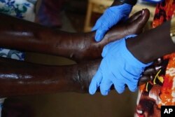 Elizabeth Nyachiew, a midwife supervisor with Doctors Without Borders, inspects a women's legs in the maternal ward with Edema during her daily round at a hospital in Bentiu, South Sudan, June 24, 2024.