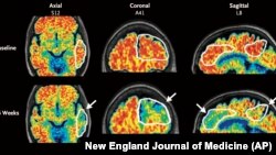 These PET scan images provided by the New England Journal of Medicine in January 2024 show a reduction in amyloid-beta levels in an Alzheimer's patient after focused ultrasound treatment to open the blood-brain barrier. (New England Journal of Medicine via AP)