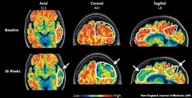 These PET scan images from January 2024 show a reduction in amyloid-beta levels in an Alzheimer's patient after focused ultrasound treatment to open the blood-brain barrier. Red is associated with higher levels of amyloid-beta levels. (New England Journal of Medicine via AP)