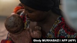 A child suffering from severe smallpox, Kavumu Hospital, Democratic Republic of the Congo, August 24, 2024.