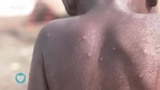 Ugonjwa wa MPOX unaendelea kuleta wasiwasi kimataifa