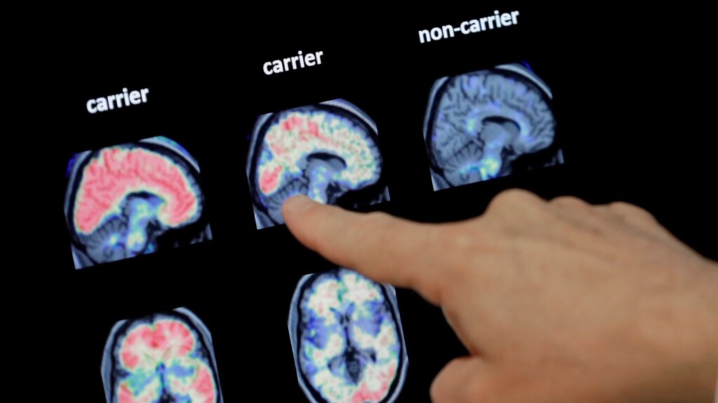 Another Alzheimer's Drug Showing Promise