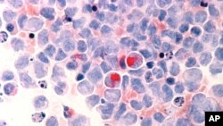 FILE - This March 1988 microscope photo provided by the National Cancer Institute shows human cells with acute myelocytic leukemia.