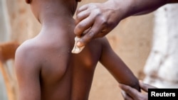 Omar Kagoma shows the marks on the skin of his 6-year-old son Moussa Niyonkuru, after he recovered from mpox, outside their house in Kinama zone, in Bujumbura, Burundi, Aug. 28, 2024. 