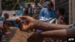 A patient suffering from mpox sits on a bench at the Kavumu hospital, 30 km north of Bukavu in eastern Democratic Republic of Congo, Aug. 24, 2024. 