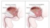 Illustration showing the size of normal and enlarged prostate. (Courtesy of the National Cancer Institute)