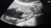 Американские врачи и правозащитники – о возможных последствиях запрета на аборт в США