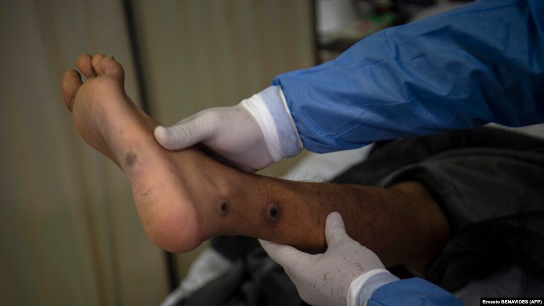 Seorang dokter memeriksa pasien yang luka akibat infeksi cacar monyet di Peru, sebagai ilustrasi. Dokter mengatakan penularan cacar monyet tidak semudah seperti halnya COVID-19.(Foto: AFP/Ernesto BENAVIDES)