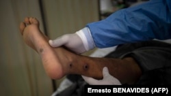 ILUSTRASI - Seorang dokter memeriksa luka pasien akibat terinfeksi cacar monyet (mpox) di ruang isolasi RS Arzobispo Loayza, Lima, 16 Agustus 2022. (AFP/Ernesto BENAVIDES)