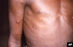 Lengan kanan dan dada seorang pasien, yang kulitnya menunjukkan sejumlah luka akibat kasus cacar monyet yang aktif. (Foto: CDC via AP)