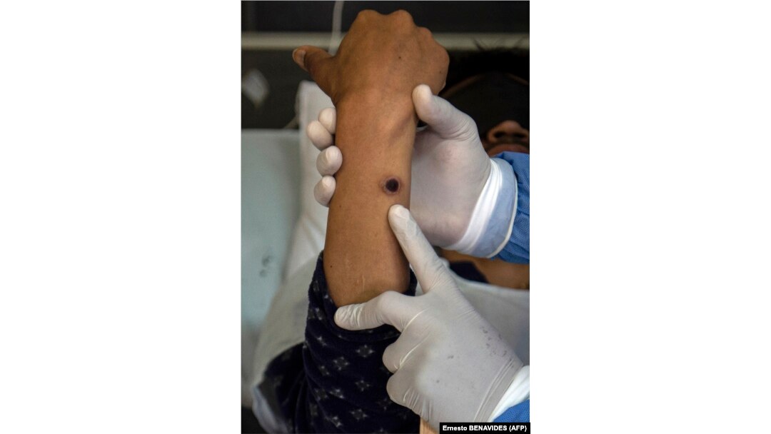 Seorang dokter memeriksa pasien yang luka akibat infeksi cacar monyet di ruang isolasi di RS Arzobispo Loayza, Lima, 16 Agustus 2022. (Foto: AFP/Ernesto BENAVIDES)