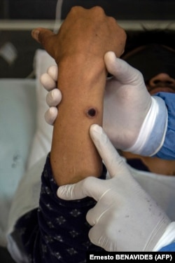 Seorang dokter memeriksa pasien yang luka akibat infeksi cacar monyet di ruang isolasi di RS Arzobispo Loayza, Lima, 16 Agustus 2022. (Foto: AFP/Ernesto BENAVIDES)