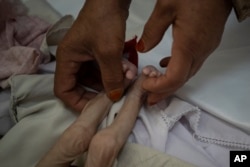 Ibu tiri Mohammed, 4 bulan, yang kekurangan gizi, memegang kakinya di rumah sakit Indira Gandhi di Kabul, Afghanistan, 8 November 2021. (Foto: AP)