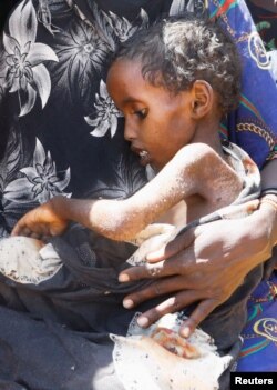 FILE - A person holds a malnourished child at the Iftin Camp for the internally displaced people outside Baradere town, Gedo Region, Jubaland state, Somalia, March 13, 2022.