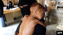 FILE - Randa, a Yemeni baby suffering from severe malnutrition, is carried by her mother as she awaits treatment at a center run by a humanitarian organization, inside a camp for the displaced, in the Abs district of Hajjah province, Dec. 21, 2021.
