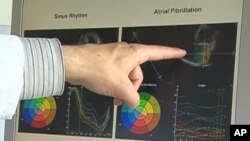 Atrijska fibrilacija - dijagnosticirana kod iznenađujuće puno žena