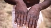 This 1997 image provided by the CDC during an investigation into an outbreak of monkeypox, which took place in the Democratic Republic of the Congo.