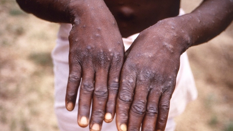 WHO Expects More Cases of Monkeypox to Emerge Globally