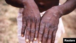 Sebuah gambar dari penyelidikan wabah cacar monyet di Republik Demokratik Kongo (DRC) sejak 1996 hingga 1997, menunjukkan tangan seorang pasien dengan ruam akibat cacar monyet. (CDC/Brian W.J. Mahy/Handout via REUTERS)