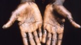 Las palmas de las manos de un paciente con viruela del mono 