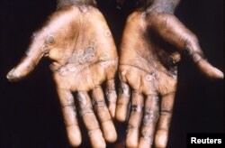 Las palmas de las manos de un paciente con viruela del mono