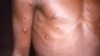 这张由CDC提供的1997年的照片显示，患有猴痘的一名男子的右臂和躯干上出现许多损伤。