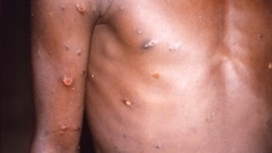 世界衛生組織：20多個國家出現了近200例猴痘病例