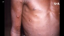 世界衛生組織：20多個國家出現了近200例猴痘病例