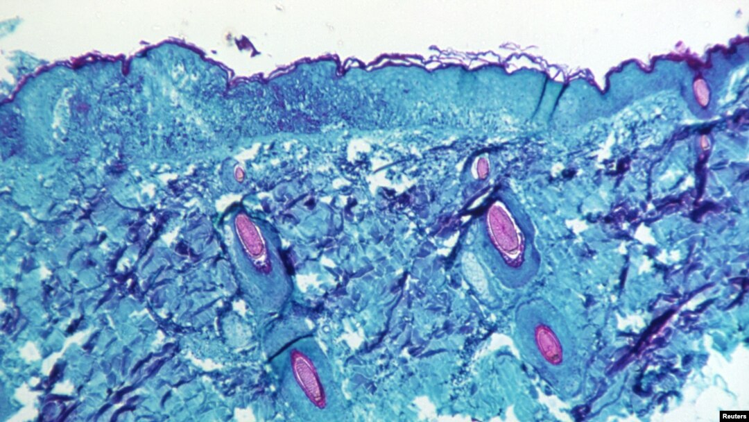 FILE - A section of skin tissue, harvested from a lesion on the skin of a monkey, that had been infected with monkeypox virus, is seen at 50X magnification on day four of rash development in 1968. (CDC/Handout via Reuters)