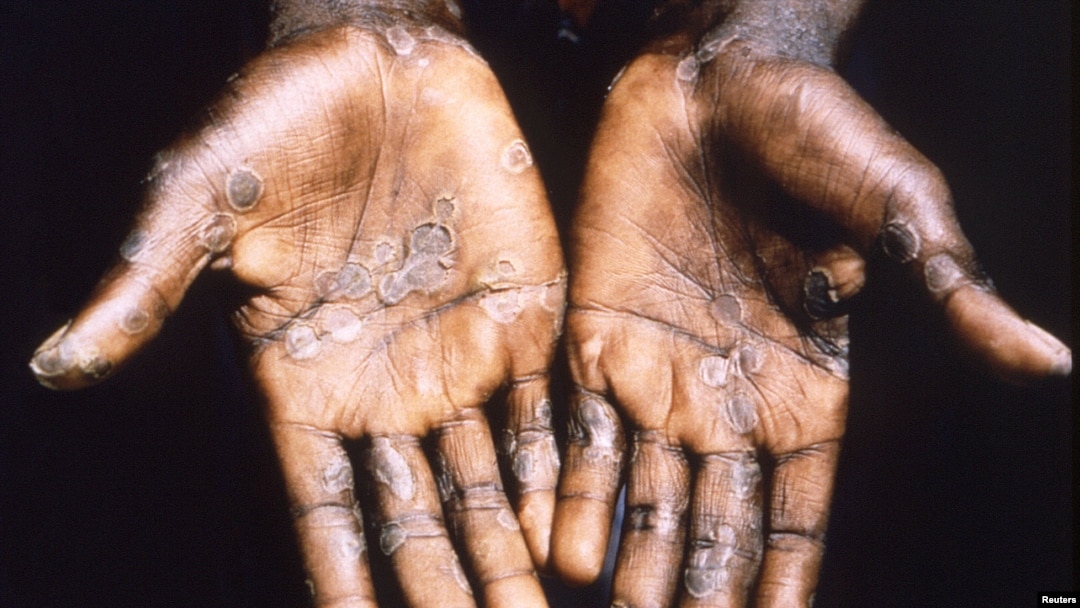 Monkeypox May Sometimes Spread Through the Air