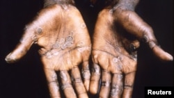 ARCHIVO - Las palmas de las manos de un paciente con viruela del simio de Lodja, en la Zona de Salud de Katako-Kombe, se ven durante una investigación de salud en la República Democrática del Congo en 1997.