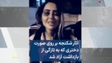 آثار شکنجه بر روی صورت دختری که به تازگی از بازداشت آزاد شد