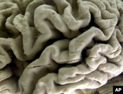 FILE - This Oct. 7, 2003 file photo shows a closeup of a human brain affected by Alzheimer's disease, on display at the Museum of Neuroanatomy at the University at Buffalo in Buffalo, N.Y. (AP Photo/David Duprey)