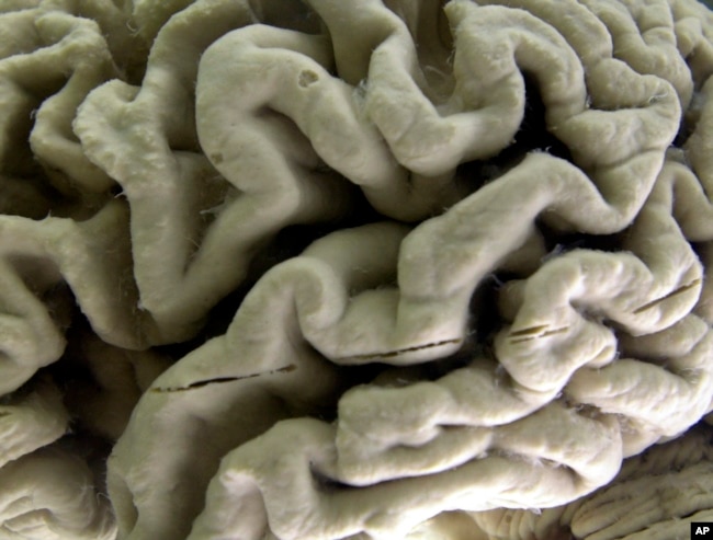 FILE - This Oct. 7, 2003 file photo shows a closeup of a human brain affected by Alzheimer's disease, on display at the Museum of Neuroanatomy at the University at Buffalo in Buffalo, N.Y. (AP Photo/David Duprey)