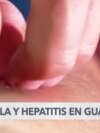 Respuesta Sanitaria contra la viruela del mono y la hepatitis en Guatemala