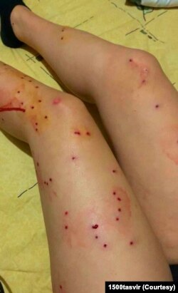 گلوله‌های ساچمه‌ای در پاهای یک زن معترض