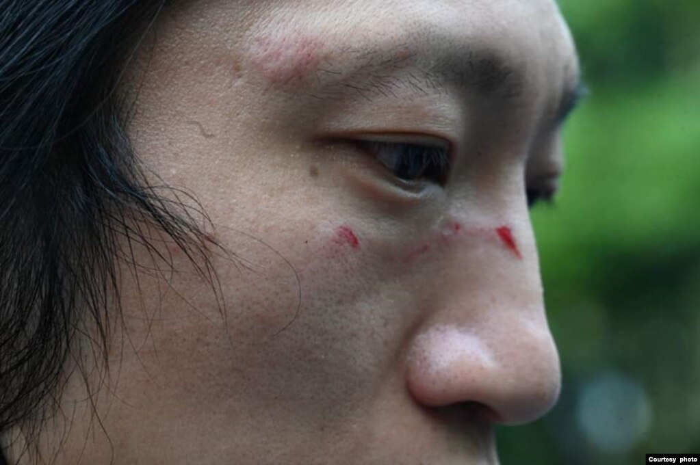 被打的示威者Bob展示伤势。 （照片来源：Matthew Leung/追新闻提供）(photo:VOA)