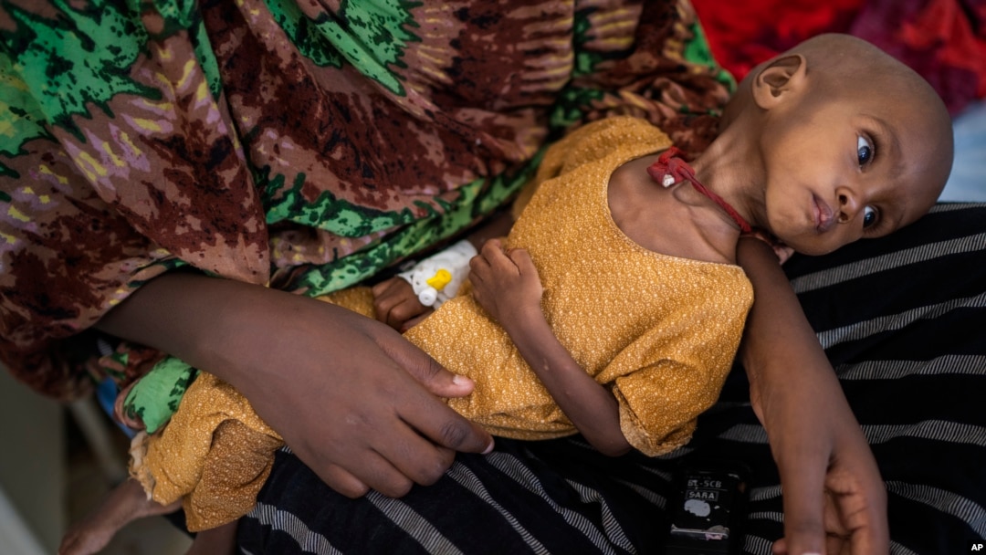 FILE - Hamdi Yusuf, a malnourished child, is held by her mother in Dollow, Somalia, Sept. 21, 2022. Somalia is still feeling the effects of the Russian invasion of Ukraine, as escalating prices for wheat and a drought are putting millions at risk of starvation.