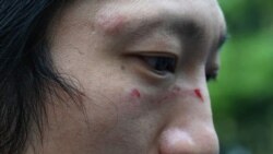 粵語新聞 晚上9-10點 : 中國領事館毆打案受傷者：襲擊“行為野蠻” 擔心家人安全但會繼續參與示威 